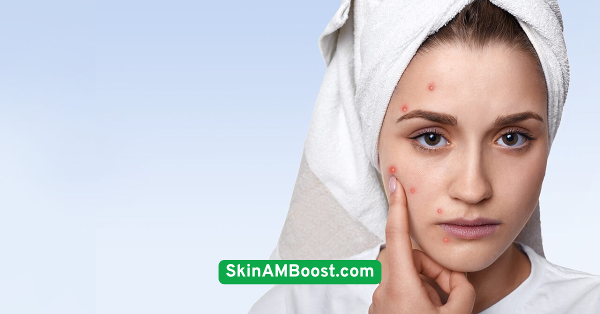 Don’t Pop Pimples