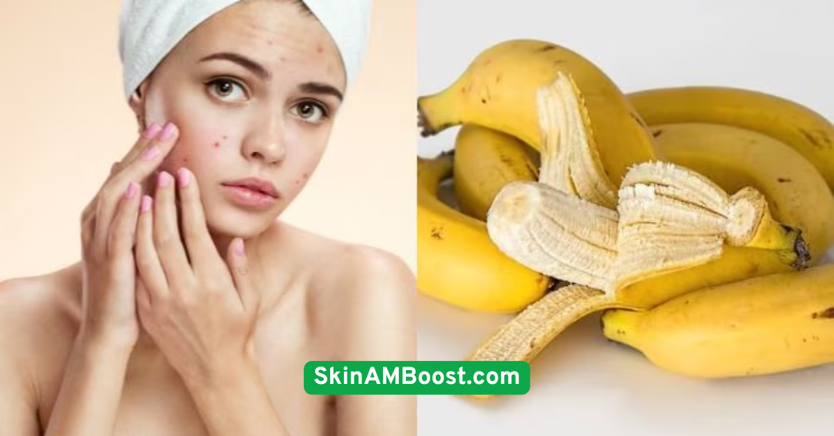 Try a Banana Peel Rub for Acne Marks